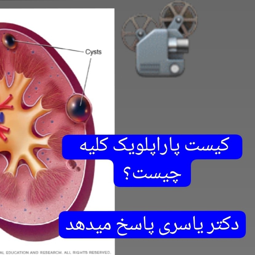 کیست‌پاراپلویک کلیه چیست؟