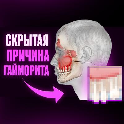 КАК ИЗБАВИТЬСЯ ОТ ГАЙМОРИТА НАВСЕГДА? УСТРАНИ ПРИЧИНУ