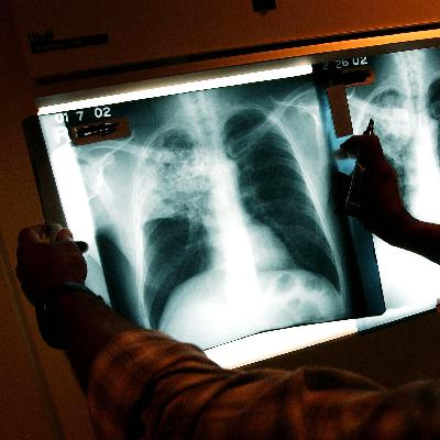 Turning the Page on Tuberculosis