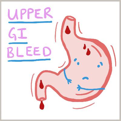 Upper GI bleeding Upper GI bleeding