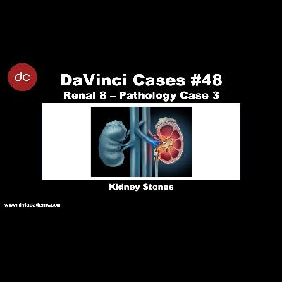 Kidney Stones [#DaVinciCases Renal 8 - Pathology Case 3]