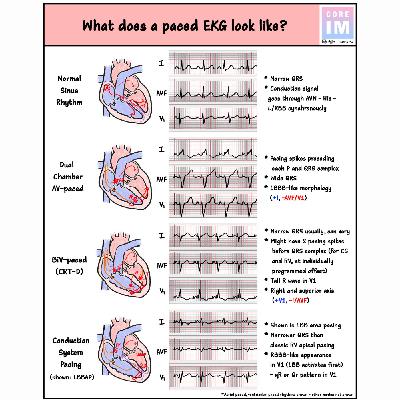 #140 Bonus Pacemaker & ICDs: 5 Pearls Segment