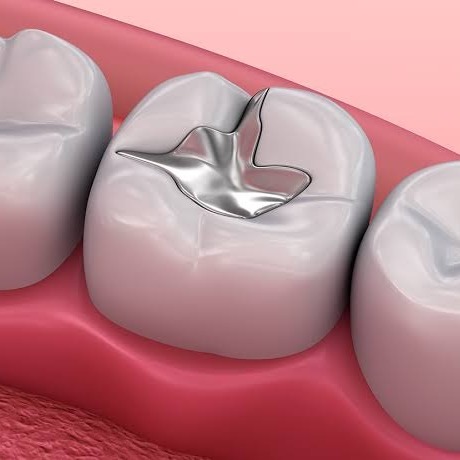 The OPTISMILE Podcast 123 - The Amalgam and Mercury Debate