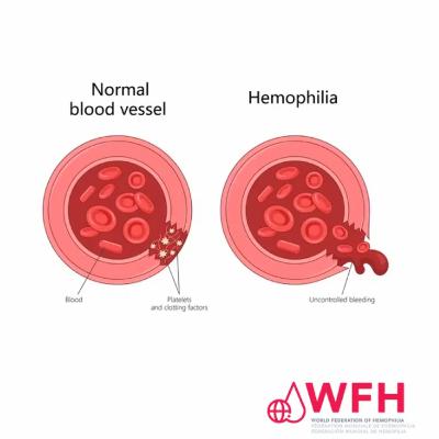 136. Global Care for People with Bleeding Disorders