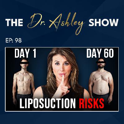 98. The TRUTH About Liposuction...(it May CAUSE Weight Gain)