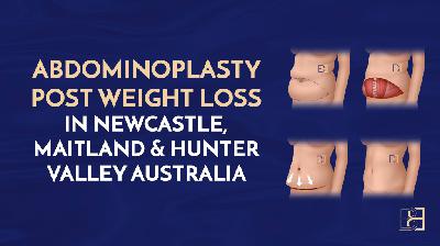 Abdominoplasty After Weight Loss: What You Need to Know