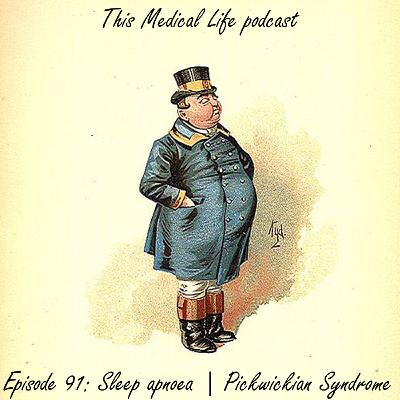 Episode 91: Sleep Apnoea | Pickwickian Syndrome