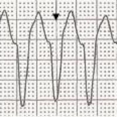Ventricular Arrhythmias, Escape Rhythms, Artifact Ventricular Arrhythmias, Escape Rhythms, Artifact