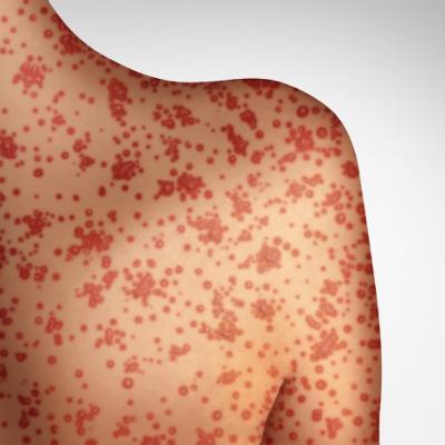 Measles Podcast