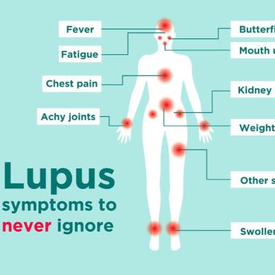11. Lupus - 16,000 cases each year - Causes, Symptoms, Types & Treatments
