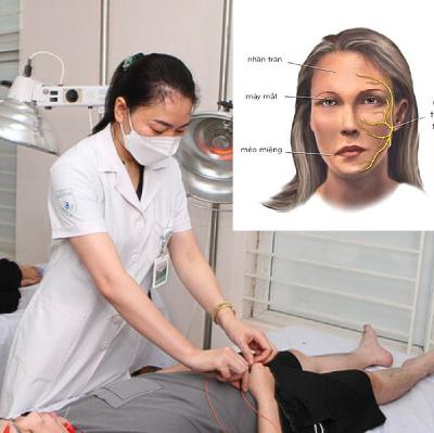 Tại sao nhiễm lạnh dễ dẫn đến liệt dây thần kinh số 7? Tại sao nhiễm lạnh dễ dẫn đến liệt dây thần kinh số 7?
