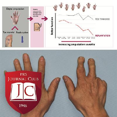 "Toe Transfers Outperform Replantation" with James Higgins, MD - Aug. 2025 Journal Club