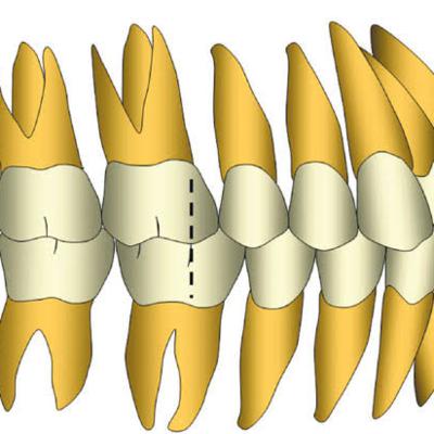 Maloclusões: Classificações de Angle