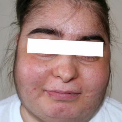 Bölüm 932: Cushing sendromu