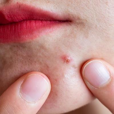 "Acne affects 35% of women and 20% of men"