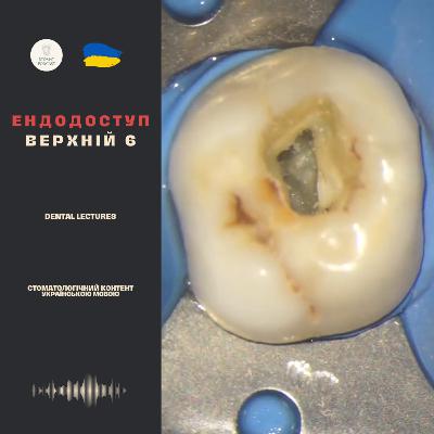 Ендо-доступ до верхнього 6 зуба