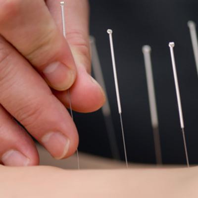 Physiotherapist & Dry needling