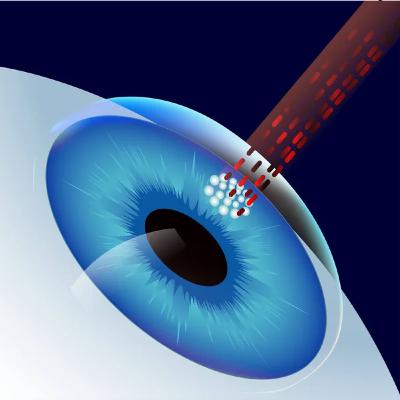 Laser-based Refractive Error Corrective Procedures