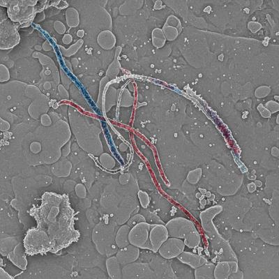 Morgellons in Northern California