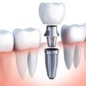 Restore Your Smile with Dental Implants in Michigan – Platinum Dental Care