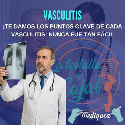 #48 Vasculitis - Podcast MIR
