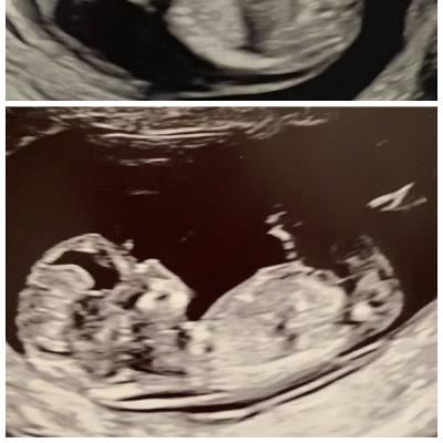 Abortion (2024)