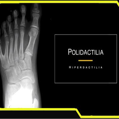 Polidactilia Genes Heredados por Seres Extraterrestres
