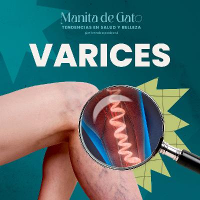 Várices y trombosis: cómo prevenir y cuidar la salud de tus piernas
