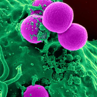 Diabetes ( niveles altos de glucosa o azúcar en sangre) Diabetes ( niveles altos de glucosa o azúcar en sangre)