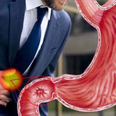 ÚLCERAS GÁSTRICAS/DUODENALES/PÉPTICAS, CAUSAS, SÍNTOMAS, COMPLICACIONES, DETECCIÓN, PREVENCIÓN👩⚕️ Aprende Fácil sobre Salud y Medicina❤️️ ÚLCERAS GÁSTRICAS/DUODENALES/PÉPTICAS, CAUSAS, SÍNTOMAS, COMPLICACIONES, DETECCIÓN, PREVENCIÓN👩⚕️ Aprende Fácil sobre Salud y Medicina❤️️