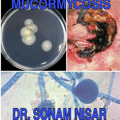 Mucormycosis