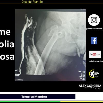 #3-Síndrome da Embolia Gordurosa no Trauma de Femur