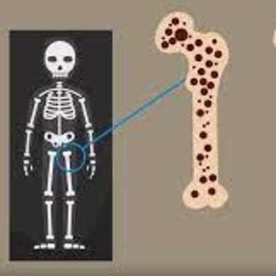 Osteoporosis