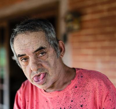 Adverse effects of antipsychotics