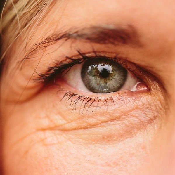 What Causes wrinkles under the eyes?