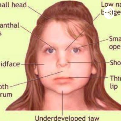 Fetal Alcohol Syndrome (FAS).