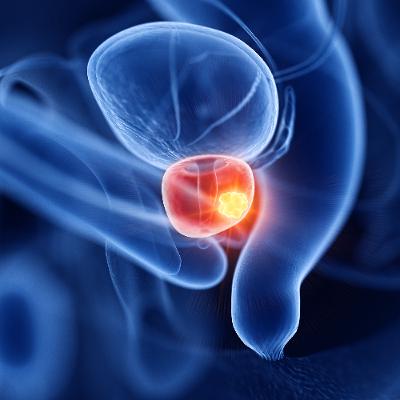 How Low Oxygen Shields Prostate Cancer from Ferroptosis Therapies