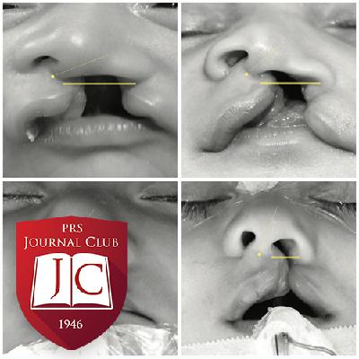 "PSIO Outcomes in UCLP" with Scott P. Bartlett, MD - Feb. 2026 Journal Club "PSIO Outcomes in UCLP" with Scott P. Bartlett, MD - Feb. 2026 Journal Club