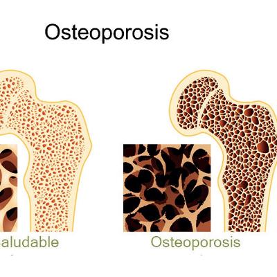 OSTEOPOROSIS