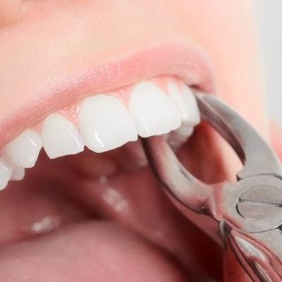 Anatomia de la cavidad oral y complicaciones en exodoncia Anatomia de la cavidad oral y complicaciones en exodoncia