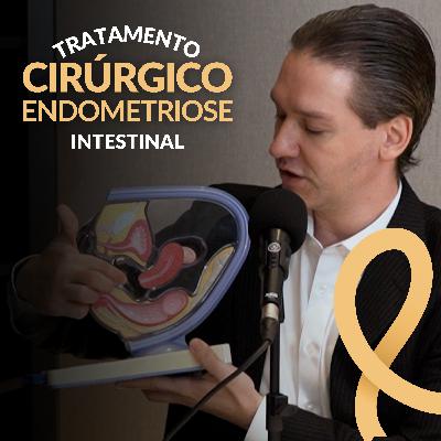 Cirurgias na Endometriose Intestinal | #6