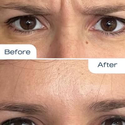 Episode #5 : Au-Delà des Rides : L'Art et la Science du Botox