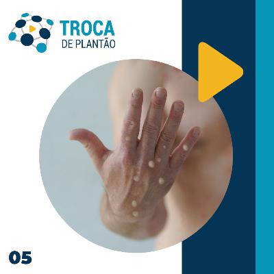 Monkeypox - Troca de Plantão S02EP05