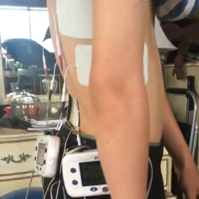 Spinal Neuromodulation in Cerebral Palsy Rehabilitation