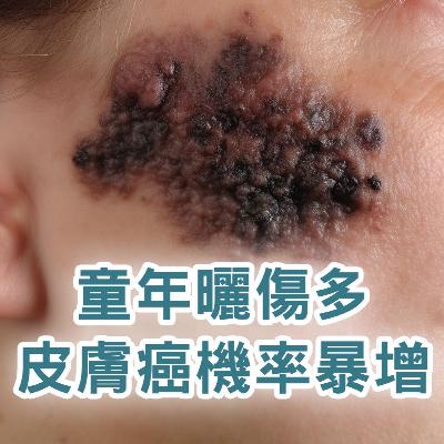 【S2 EP.102】童年多次曬傷,長大皮膚癌機率暴增! 【S2 EP.102】童年多次曬傷,長大皮膚癌機率暴增!