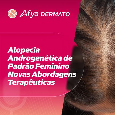 Alopecia androgenética de padrão feminino novas abordagens terapêuticas Alopecia androgenética de padrão feminino novas abordagens terapêuticas