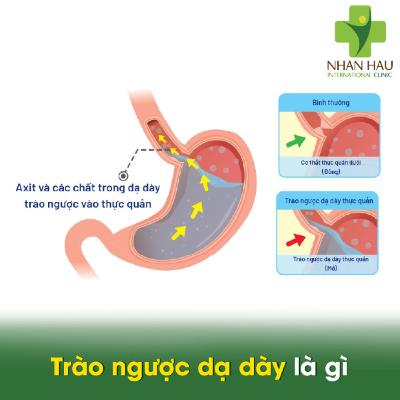 Trào ngược dạ dày là gì? triệu chứng, nguyên nhân và cách điều trị Trào ngược dạ dày là gì? triệu chứng, nguyên nhân và cách điều trị