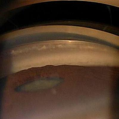 Angle Closure Disease-Practice Update