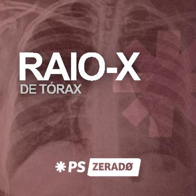 Raio-X de Tórax no Plantão Sinais Clássicos sem Mistério