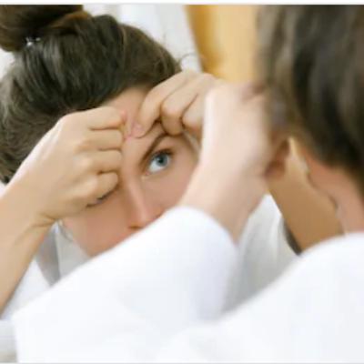 Home Remedies for acne